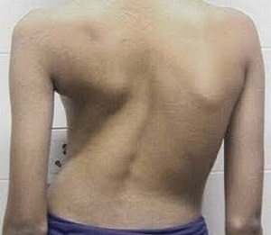 a escoliose como causa de dores nas costas