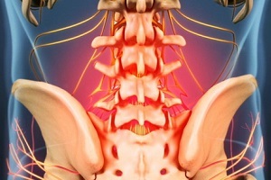 causas e síntomas da osteocondrose