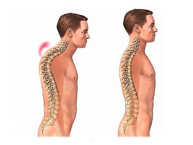 Cifose espinal