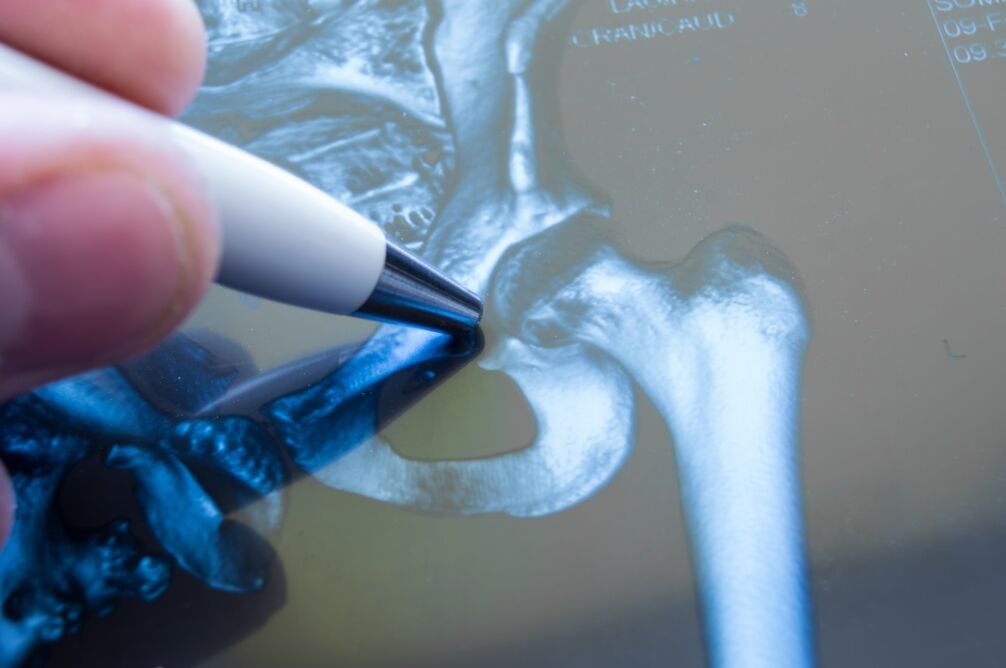 Artrose da articulación da cadeira na radiografía
