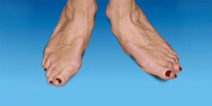 deformidade do pé con artrose do nocello