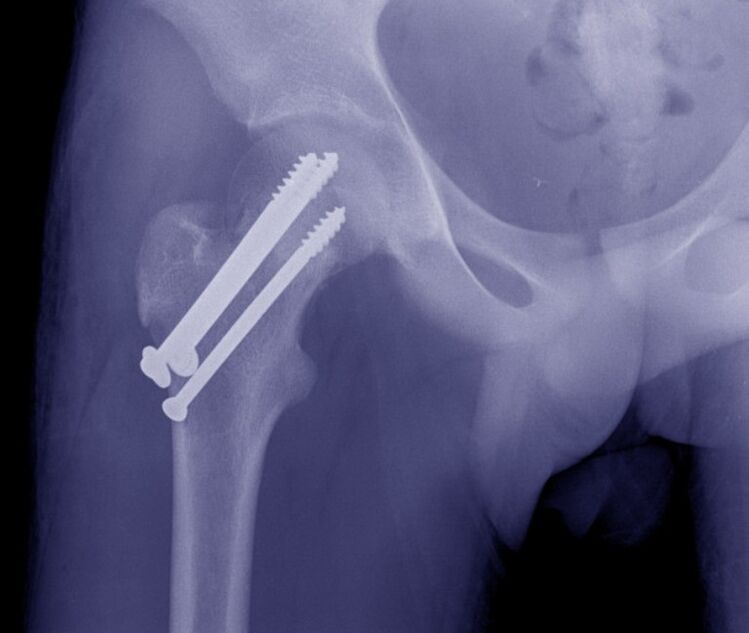 Radiografía da articulación da cadeira, osteosíntese da fractura con dispositivos de fixación interna
