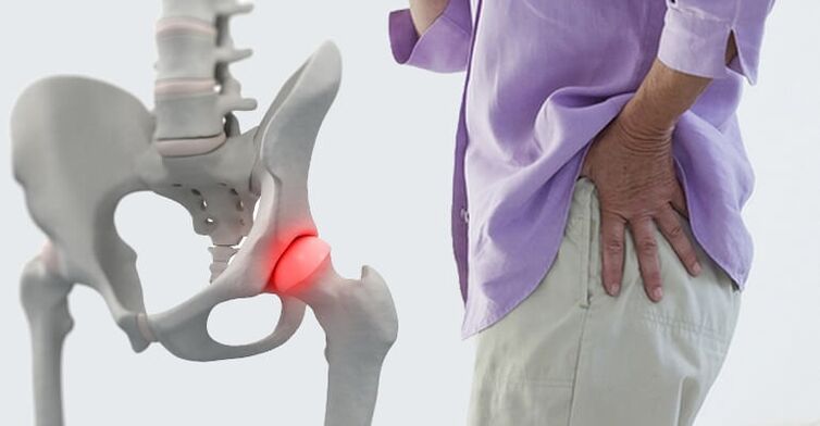 dor na zona da cadeira - un síntoma de artrose da articulación da cadeira