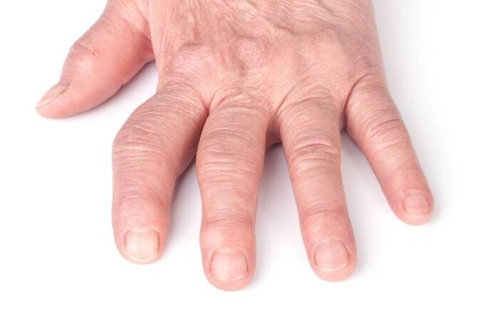 artrose deformante nas mans