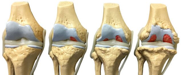 danos nas articulacións en diferentes etapas do desenvolvemento da artrose do nocello