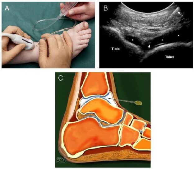 ecografía da articulación do nocello con artrose