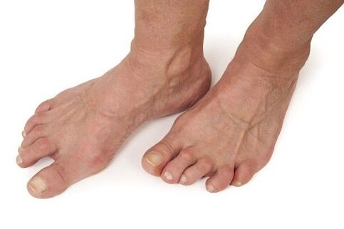 pés afectados por artrose