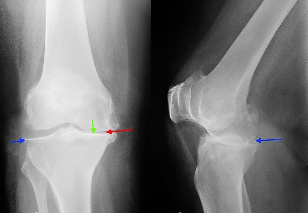 radiografía da artrose da articulación do xeonllo