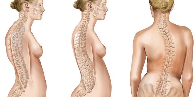 A escoliose da columna vertebral torácica provoca dor nos omóplatos