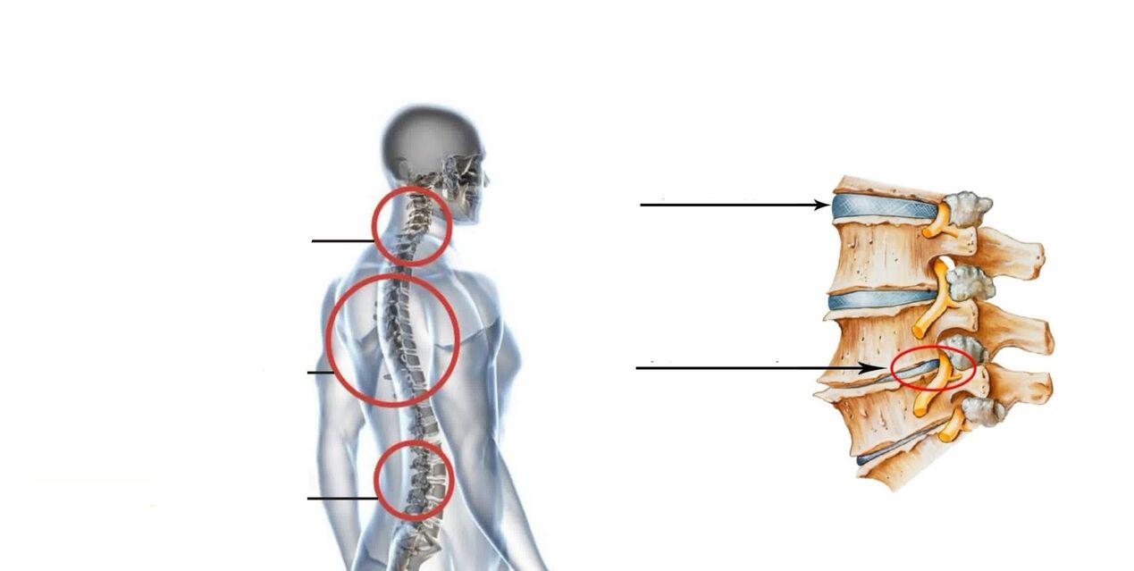 ostecondrose da columna vertebral